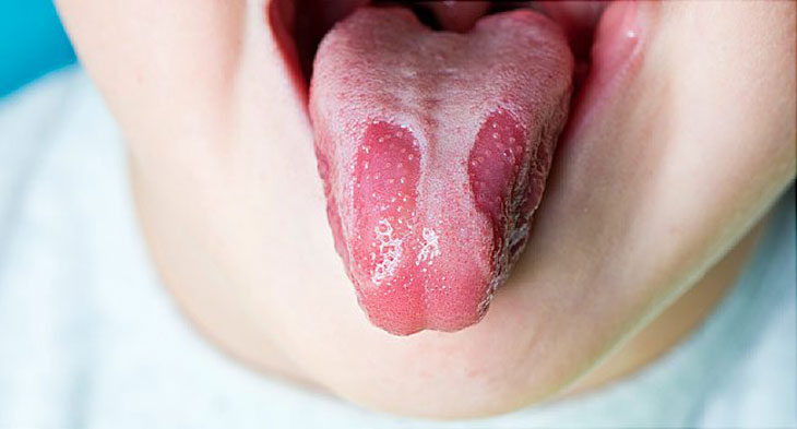 Các loại bệnh về lưỡi thường gặp nhất