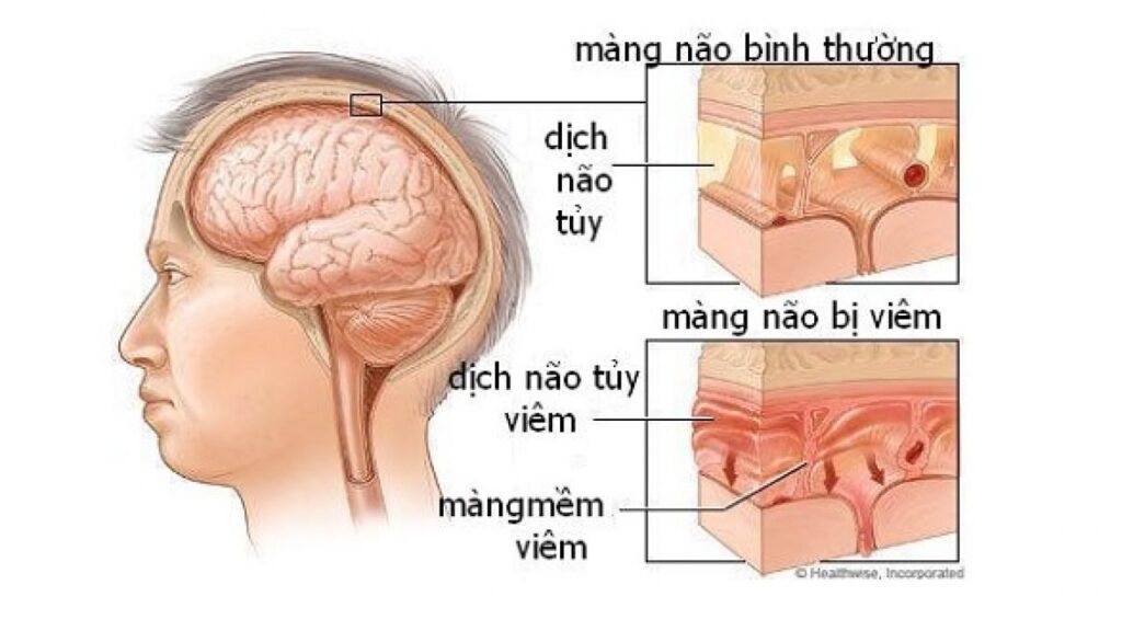 Điều cần biết về bệnh viêm màng não và viêm não ở trẻ em