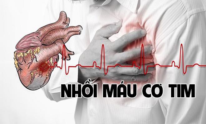 Đột tử - biến chứng nguy hiểm nhất của nhồi máu cơ tim