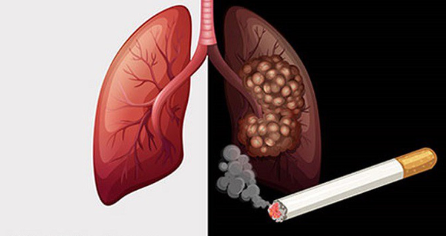 Hút thuốc là một trong những nguy cơ gây ung thư phổi