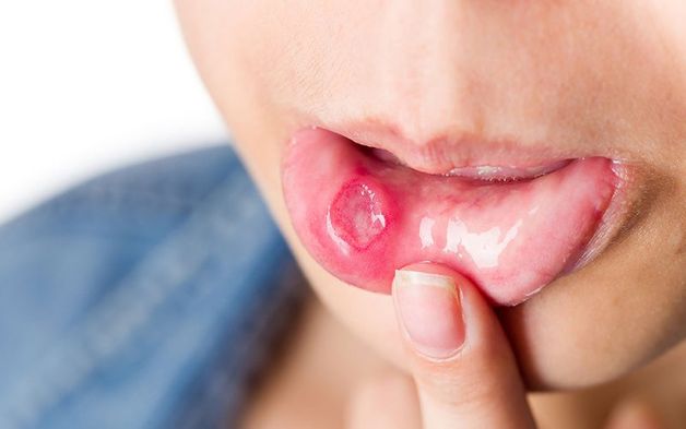 Nhiệt miệng và các cách điều trị nhiệt miệng mà bạn nên biết