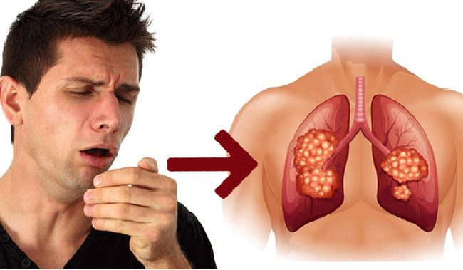 Ung thư phổi và triệu chứng ho kéo dài khó lường